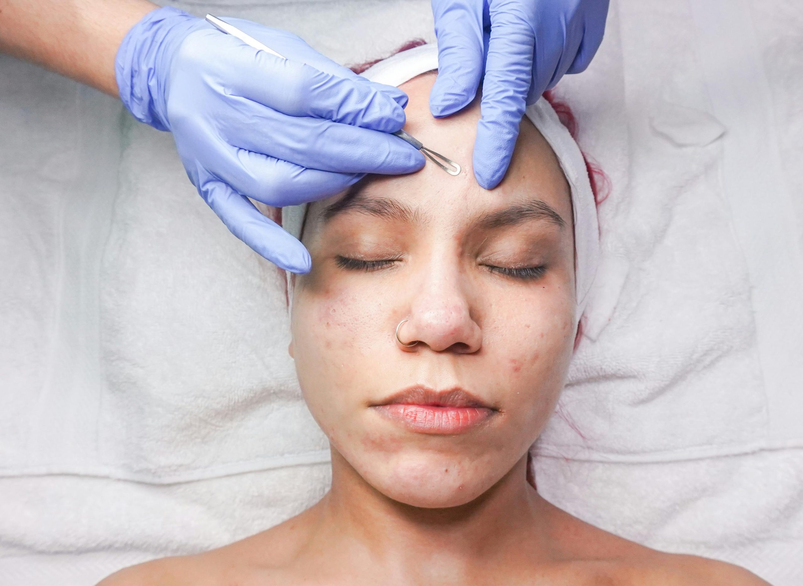 Squalane is helpful for acne