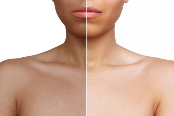 Natural looking sunless tanning result achieved using Erythrulose based self tanning cosmetic products